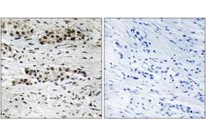 Immunohistochemistry analysis of paraffin-embedded human breast carcinoma, using Estrogen Receptor-alpha (Phospho-Ser102) Antibody. (Estrogen Receptor alpha 抗体  (pSer102))