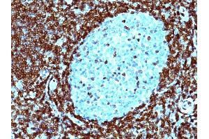 Formalin-fixed, paraffin-embedded human non-Hodgkin's Lymphoma stained with Bcl-2 Monoclonal Antibody (SPM530).