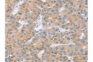The image on the left is immunohistochemistry of paraffin-embedded Human liver cancer tissue using ABIN7131090(SLC27A2 Antibody) at dilution 1/20, on the right is treated with fusion protein. (SLC27A2 抗体)