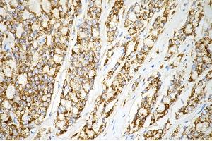 Immunohistochemistry was performed on paraffin-embedded human prostatic adenocarcinoma using arg2 antibody (ABIN7797644), 1:200). (Recombinant ARG2 抗体)