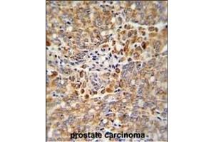Formalin-fixed and paraffin-embedded human prostate carcinoma reacted with ALKBH3 Antibody (C-term), which was peroxidase-conjugated to the secondary antibody, followed by DAB staining. (ALKBH3 抗体  (C-Term))