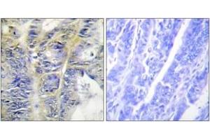 Immunohistochemistry analysis of paraffin-embedded human colon carcinoma tissue, using Collagen IV alpha5 Antibody. (COL4a5 抗体  (AA 21-70))