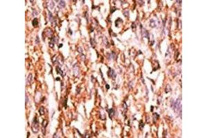 IHC analysis of FFPE human hepatocarcinoma tissue stained with the phospho-KDR antibody. (VEGFR2/CD309 抗体  (pTyr996))