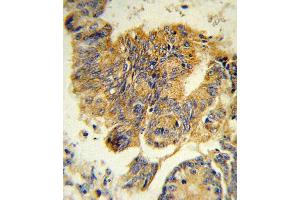Formalin-fixed and paraffin-embedded human colon carcinoma reacted with CSF3R Antibody , which was peroxidase-conjugated to the secondary antibody, followed by DAB staining. (G-CSF 抗体  (AA 252-280))