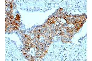 Formalin-fixed, paraffin-embedded human Lung SqCC stained with TRIM29 Mouse Monoclonal Antibody (TRIM29/1041). (TRIM29 抗体  (AA 1-200))