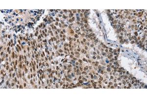 Immunohistochemistry of paraffin-embedded Human lung cancer tissue using GNRH1 Polyclonal Antibody at dilution 1:65 (GNRH1 抗体)