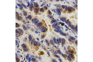 Immunohistochemical analysis of Caspase 9 p35 staining in human lung cancer formalin fixed paraffin embedded tissue section. (Caspase 9 p35 抗体)