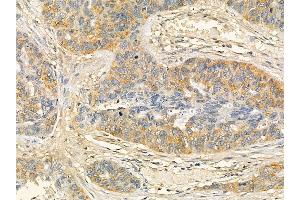 OR1E1 Mouse Monoclonal Antibody at 1/100 staining human lung cancer and adjacent non-tumor tissue by IHC-P.