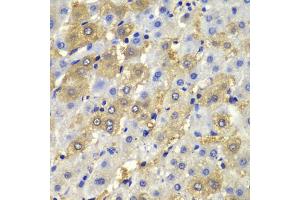 Immunohistochemistry of paraffin-embedded human liver injury using DSP antibody (ABIN5975859) at dilution of 1/100 (40x lens).
