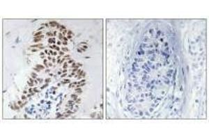 Immunohistochemistry analysis of paraffin-embedded human lung carcinoma tissue using DAPK3 (Ab-265) antibody. (DAPK3 抗体  (Thr265))