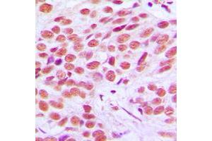 Immunohistochemical analysis of FRA2 staining in human breast cancer formalin fixed paraffin embedded tissue section. (FOSL2 抗体  (C-Term))