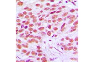 Immunohistochemical analysis of FRA2 staining in human breast cancer formalin fixed paraffin embedded tissue section.