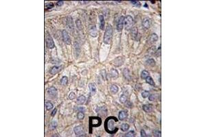 Formalin-fixed and paraffin-embedded human prostate carcinoma tissue reacted with CDH3 antibody , which was peroxidase-conjugated to the secondary antibody, followed by DAB staining. (P-Cadherin 抗体  (C-Term))