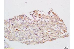 Formalin-fixed and paraffin embedded human cervical carcinoma tissue labeled with Anti-CYP24A1 Polyclonal Antibody, Unconjugated  at 1:200 followed by conjugation to the secondary antibody and DAB staining