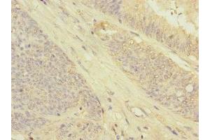 Immunohistochemistry of paraffin-embedded human colon cancer using ABIN7154564 at dilution of 1:100 (GRPEL2 抗体  (AA 33-225))