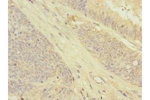 Immunohistochemistry of paraffin-embedded human colon cancer using ABIN7154564 at dilution of 1:100