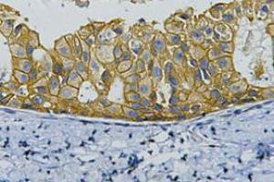Immunohistochemistry (IHC) staining of Human Breast cancer tissue, diluted at 1:200. (ErbB2/Her2 抗体)
