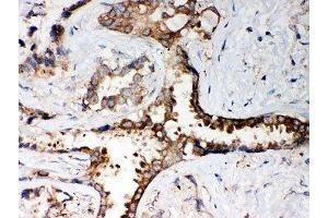IHC-P: PP2A antibody testing of human lung cancer tissue