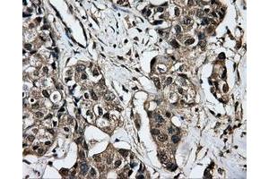 Immunohistochemical staining of paraffin-embedded Adenocarcinoma of breast tissue using anti-PPME1 mouse monoclonal antibody. (PPME1 抗体)
