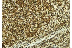 ABIN6277725 at 1/100 staining Human breast cancer tissue by IHC-P. (ATR 抗体  (pSer428))