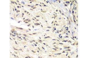 Immunohistochemistry of paraffin-embedded Human gastric cancer using CHEK1 Polyclonal Antibody at dilution of 1:100 (40x lens). (CHEK1 抗体)