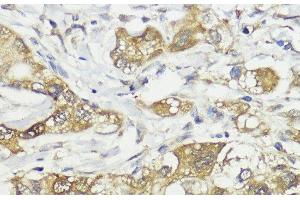 Immunohistochemistry of paraffin-embedded Human liver cancer using HACE1 Polyclonal Antibody at dilution of 1:100 (40x lens). (HACE1 抗体)