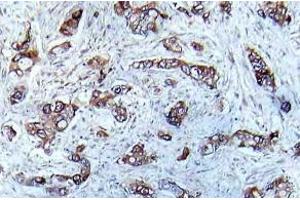 Immunohistochemistry (IHC) analyzes of p-CaMK2-a antibody in paraffin-embedded human breast carcinoma tissue. (CAMK2A 抗体  (pThr286))