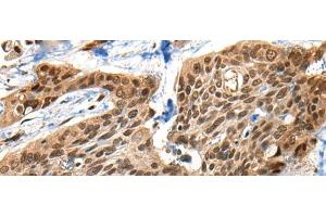Immunohistochemistry of paraffin-embedded Human esophagus cancer tissue using XPO1 Polyclonal Antibody at dilution of 1:40(x200) (XPO1 抗体)