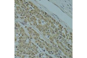 Immunohistochemistry of paraffin-embedded human colon carcinoma using RSRC1 antibody (ABIN5974341) at dilution of 1/100 (40x lens). (RSRC1 抗体)