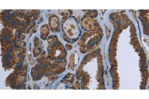 Immunohistochemistry of paraffin-embedded Human thyroid cancer using GCK Polyclonal Antibody at dilution of 1:40 (GCK 抗体)