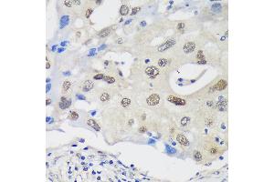 Immunohistochemistry of paraffin-embedded Human breast cancer using UCKL1 Rabbit pAb (ABIN7271233) at dilution of 1:100 (40x lens). (UCKL1 抗体  (AA 1-200))
