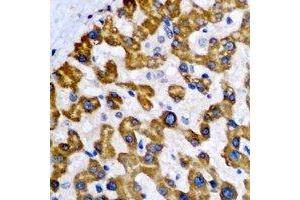 Immunohistochemical analysis of NDUFA2 staining in human liver cancer formalin fixed paraffin embedded tissue section. (NDUFA2 抗体)