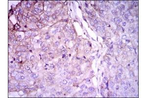 Immunohistochemical analysis of paraffin-embedded lung cancer tissues using RAB4A mouse mAb with DAB staining.