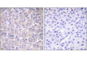 Immunohistochemistry analysis of paraffin-embedded human breast carcinoma, using EGFR (Phospho-Thr693) Antibody. (EGFR 抗体  (pThr693))