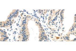 Immunohistochemistry of paraffin-embedded Human thyroid cancer using INHBB Polyclonal Antibody at dilution of 1/40 (INHBB 抗体)