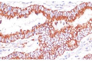 Immunohistochemistry of paraffin-embedded Human colon carcinoma using ENTPD6 Polyclonal Antibody at dilution of 1:100 (40x lens). (ENTPD6 抗体)