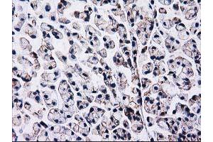 Immunohistochemical staining of paraffin-embedded Adenocarcinoma of Human colon tissue using anti-CTNNB1 mouse monoclonal antibody. (CTNNB1 抗体)
