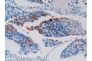 IHC-P analysis of Human Lung Cancer Tissue, with DAB staining. (c-MET 抗体  (AA 1092-1379))