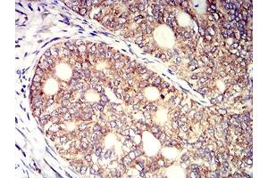Immunohistochemical analysis of paraffin-embedded cervical cancer tissues using KIR3DL1 mouse mAb with DAB staining. (KIR3DL1 抗体  (AA 22-340))