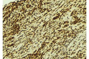 ABIN6274262 at 1/100 staining Human breast cancer tissue by IHC-P. (CSNK1A1 抗体  (Internal Region))