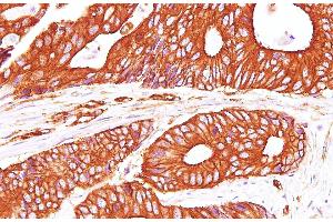 Immunohistochemistry of paraffin-embedded Human carcinoma of Colon using Sptan1 Polyclonal Antibody at dilution of 1:100(400x) (SPTAN1 抗体)