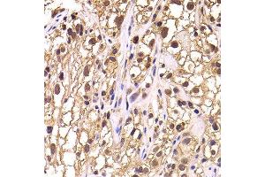 Immunohistochemistry of paraffin-embedded human kidney cancer using TCEB3 antibody at dilution of 1:100 (x400 lens). (TCEB3 抗体)