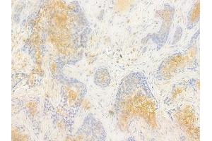 ABIN7096990 and ABIN7101057 at 1/100 staining human breast carcinoma by IHC-P. (ADSSL1 抗体)