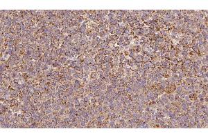 ABIN6273193 at 1/100 staining Human lymph cancer tissue by IHC-P. (ARHGDIB 抗体  (N-Term))