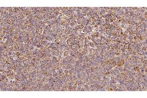 ABIN6273193 at 1/100 staining Human lymph cancer tissue by IHC-P. (ARHGDIB 抗体  (N-Term))