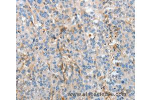 Immunohistochemistry of Human esophagus cancer using APOH Polyclonal Antibody at dilution of 1:30 (APOH 抗体)