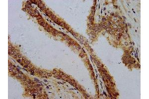 IHC image of ABIN7162643 diluted at 1:700 and staining in paraffin-embedded human prostate cancer performed on a Leica BondTM system. (PTH 抗体  (AA 32-115))