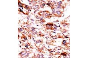 Formalin-fixed and paraffin-embedded human cancer tissue reacted with the primary antibody, which was peroxidase-conjugated to the secondary antibody, followed by AEC staining. (ADCK5 抗体  (C-Term))