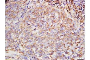 Formalin-fixed and paraffin embedded human lung carcinoma labeled with Rabbit Anti-Hyaluronidase2 Polyclonal Antibody, Unconjugated  at 1:200 followed by conjugation to the secondary antibody and DAB staining (HYAL2 抗体  (AA 111-210))
