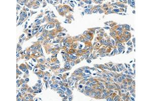 Immunohistochemical analysis of paraffin-embedded Human lung cancer tissue using at dilution 1/50. (CCL23 抗体  (C-Term))
